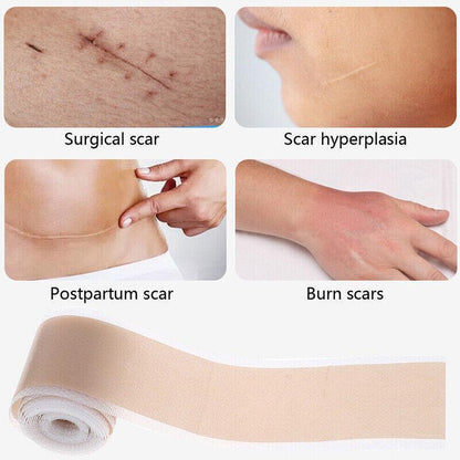 Silicone Gel Tape Scar Removal Self-Adhesive Efficient Scar Removal Patch Tapes - 4*150CM